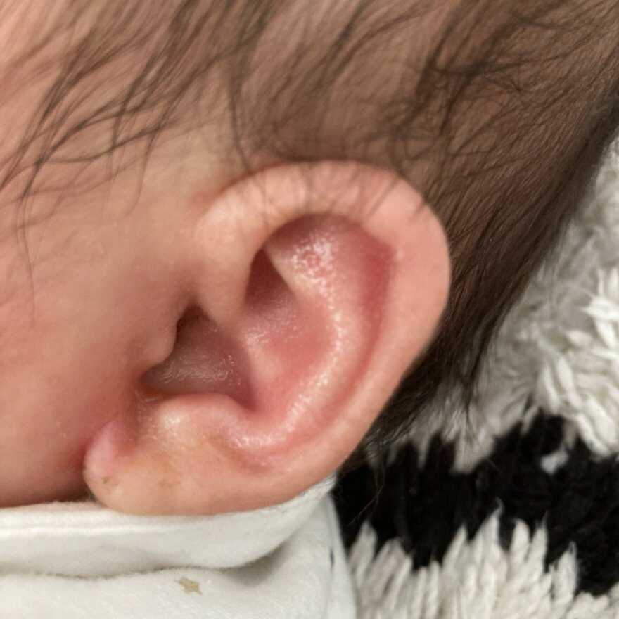 新生児・生後1・2か月耳たぶに黄色いかさぶた？赤ちゃんの脂漏性湿疹にベビーワセリン！ ほのぼのKarin