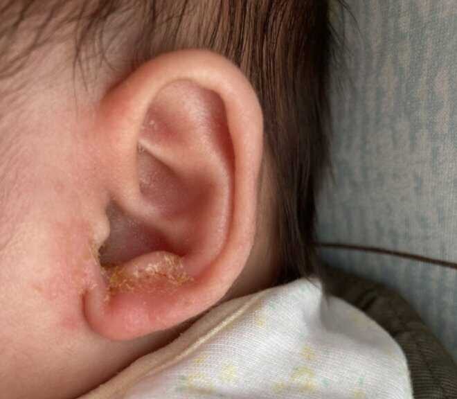 耳に黄色いかさぶたができた赤ちゃん